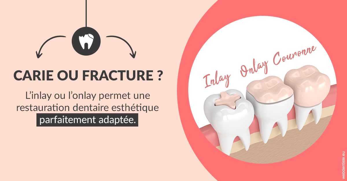 https://dr-meyer-jm.chirurgiens-dentistes.fr/T2 2023 - Carie ou fracture 2