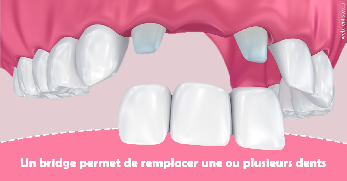 https://dr-meyer-jm.chirurgiens-dentistes.fr/Bridge remplacer dents 2