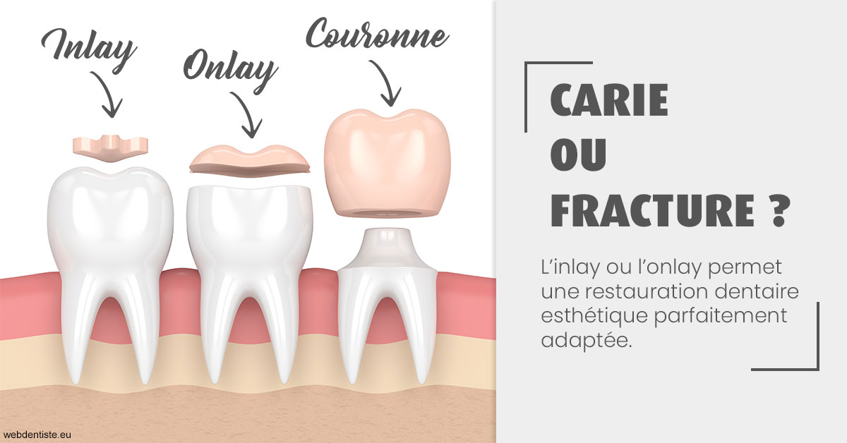 https://dr-meyer-jm.chirurgiens-dentistes.fr/T2 2023 - Carie ou fracture 1