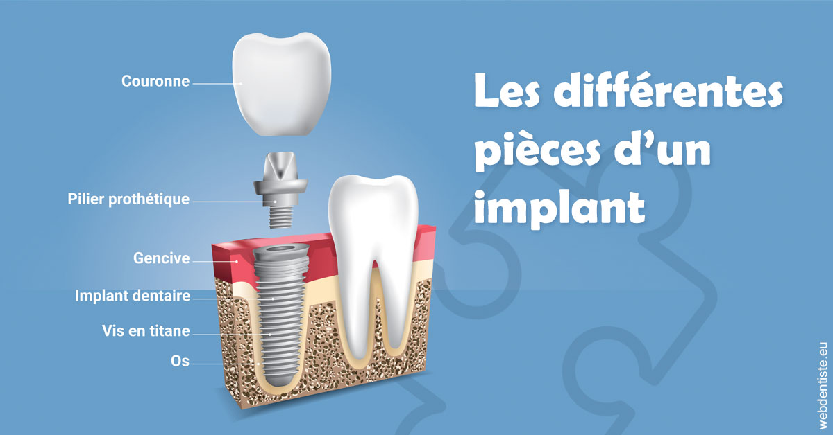 https://dr-meyer-jm.chirurgiens-dentistes.fr/Les différentes pièces d’un implant 1